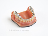 Image of partial denture